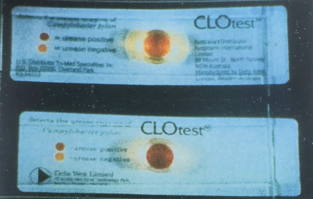 تست CLO در تشخیص هلیکوباکتر پیلوری