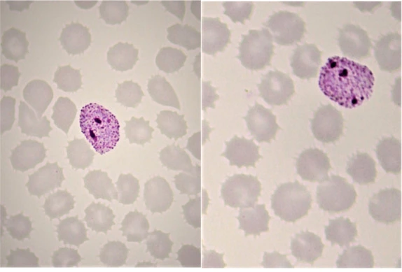 Plasmodium ovale
